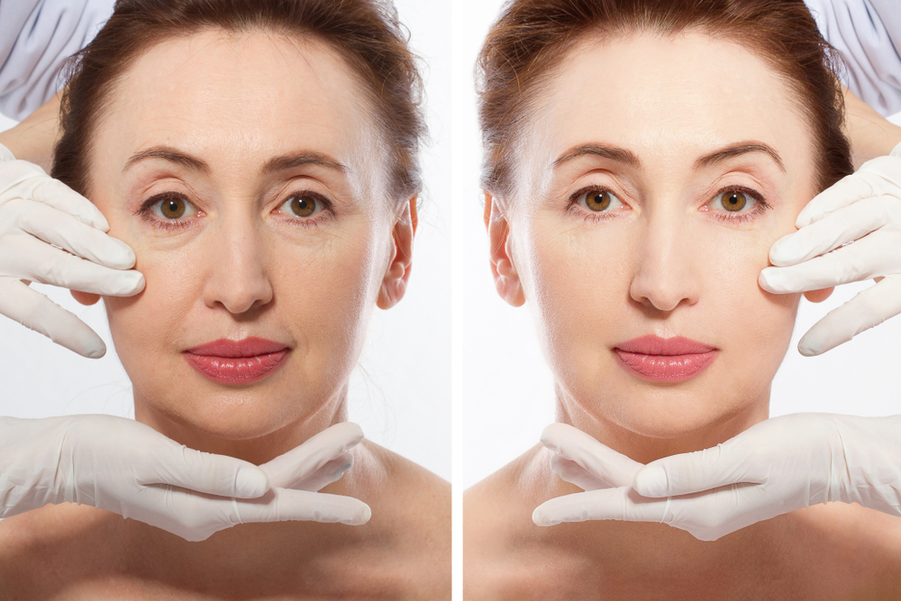 Mini Facelifts 101: Everything You Need to Know About This Procedure | South Bay Aesthetics Plastic Surgery