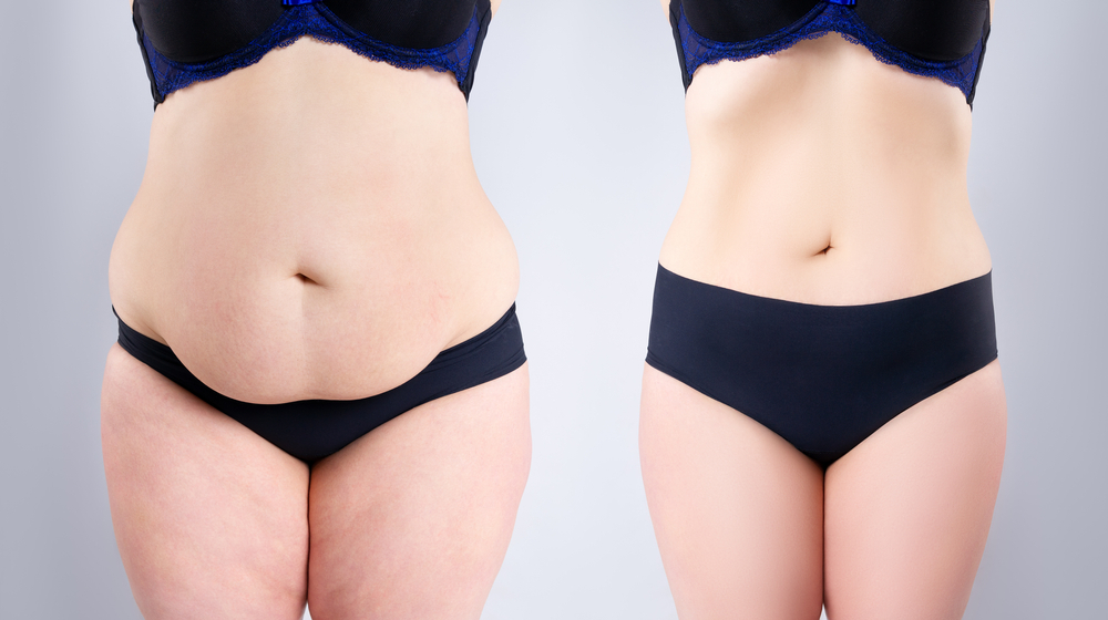 Tummy Tuck Recovery: Tips and Tricks for a Smooth Healing Process | South Bay Aesthetics Plastic Surgery