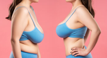 The Role of Insurance: Will Your Breast Reduction Surgery Be Covered?