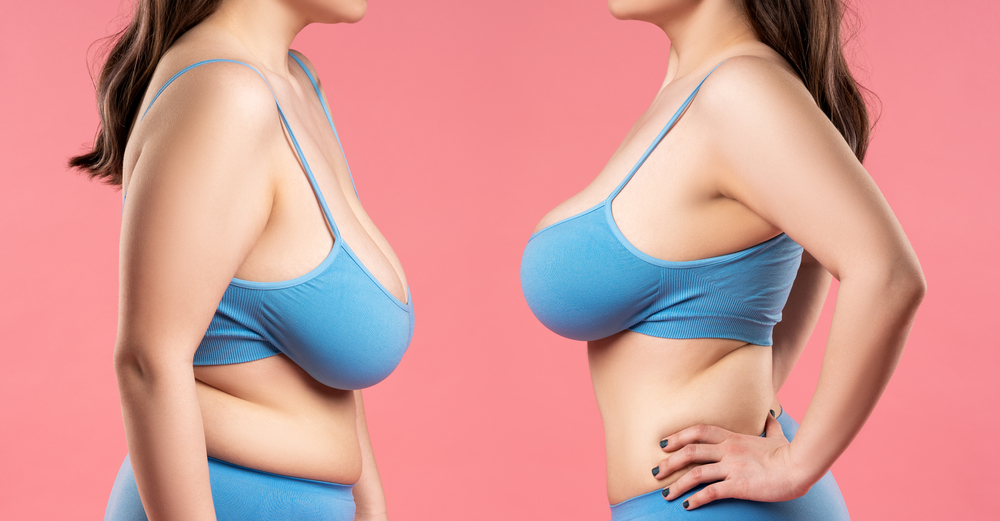 The Role of Insurance Will Your Breast Reduction Surgery Be Covered | South Bay Aesthetics Plastic Surgery
